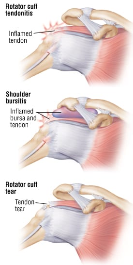 Patient Basics: Rotator Cuff Injury
