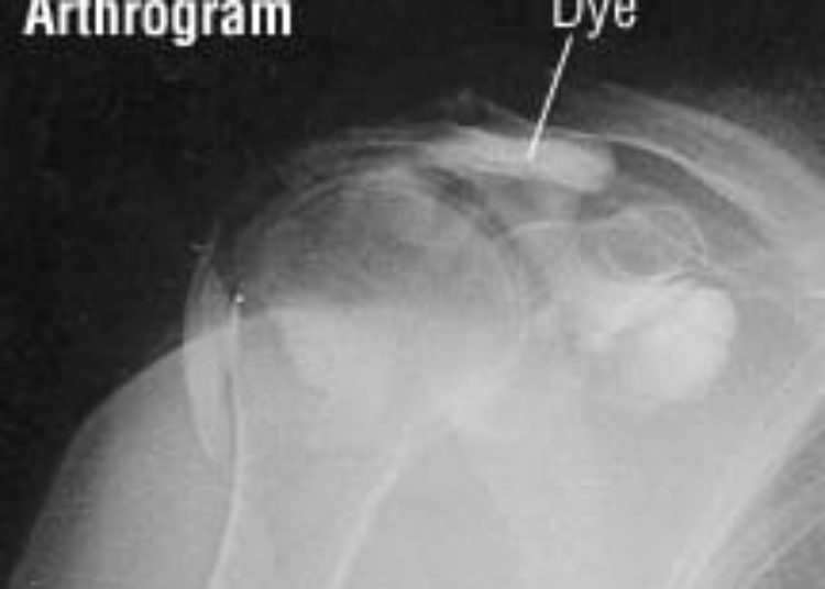 Patient Basics: Rotator Cuff Injury