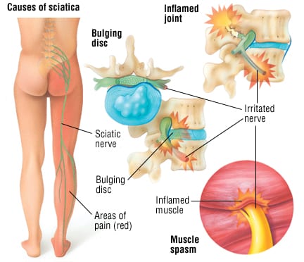 Causes of Sciatica and Sciatic Nerve Pain