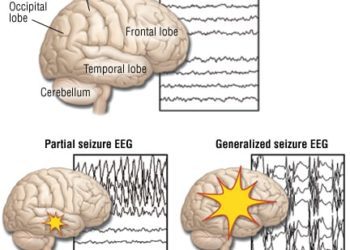 Patient Basics: Seizure