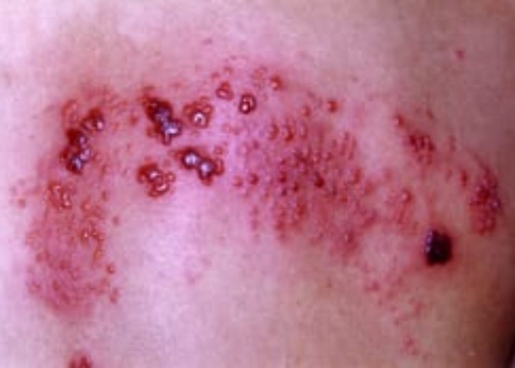 Patient Basics: Shingles (Herpes Zoster)