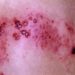 Patient Basics: Shingles (Herpes Zoster)