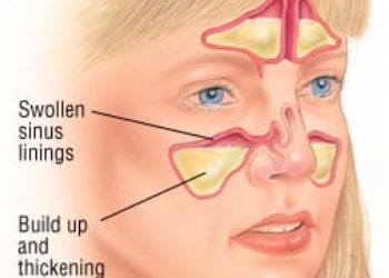 Patient Basics: Acute Sinusitis