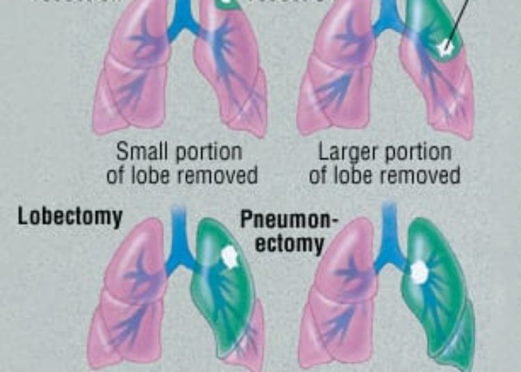 Patient Basics: Squamous Cell Carcinoma of the Lung