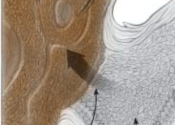 Patient Basics: Squamous Cell Carcinoma of the Skin