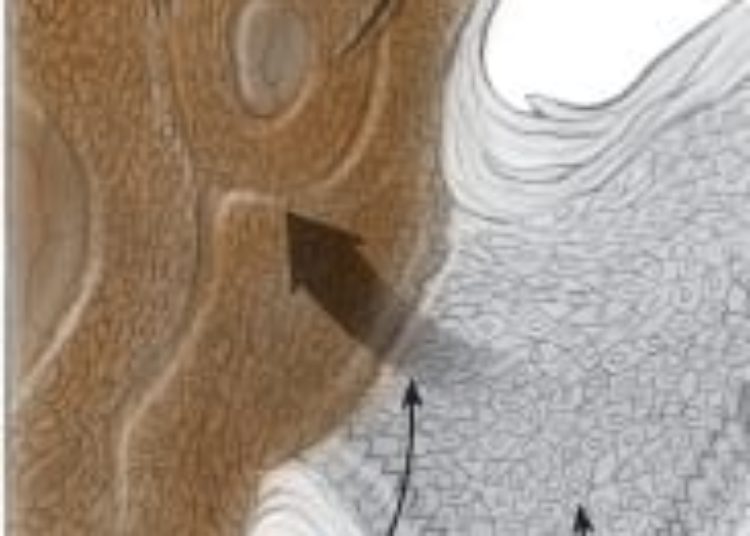 Patient Basics: Squamous Cell Carcinoma of the Skin