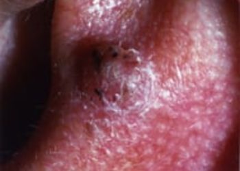 Patient Basics: Squamous Cell Carcinoma of the Skin