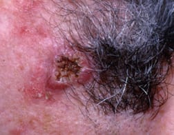 Squamous Cell Carcinoma of the Skin2