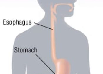 Patient Basics: Stomach Cancer