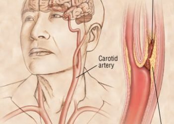 Patient Basics: Stroke Overview