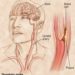 Patient Basics: Stroke Overview
