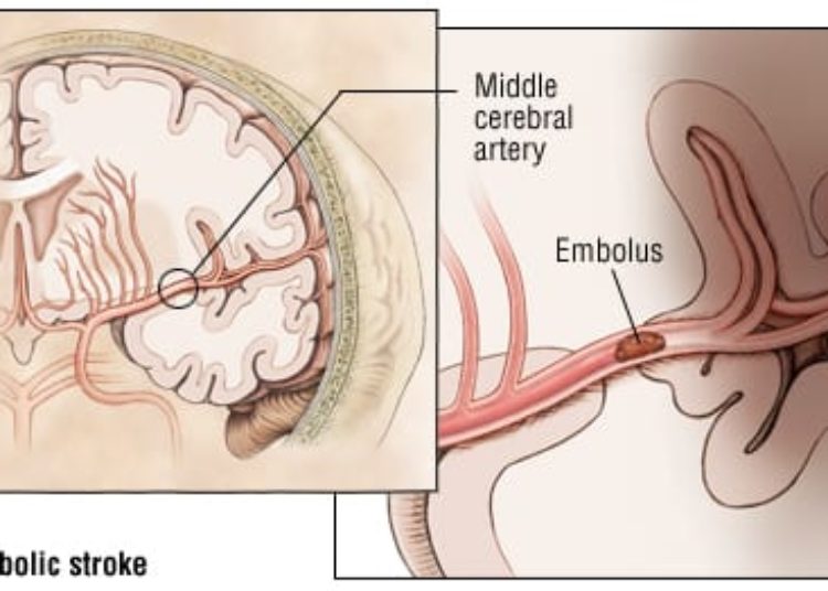 Patient Basics: Stroke Overview