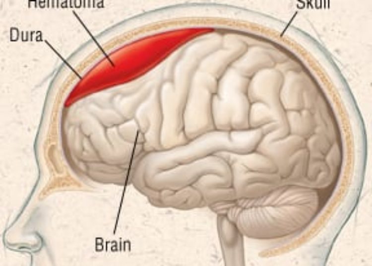 Patient Basics: Subdural Hematoma