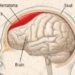 Patient Basics: Subdural Hematoma