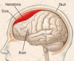 Patient Basics: Subdural Hematoma | 2 Minute Medicine