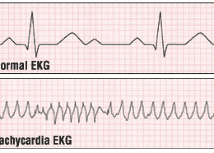 Patient Basics: Tachycardia