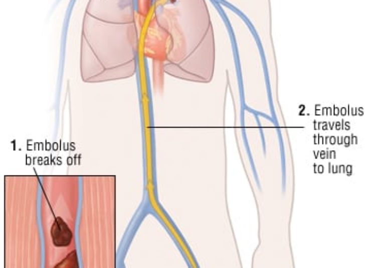 Patient Basics: Thromboembolism (Deep Vein Thrombosis and Pulmonary Embolism)