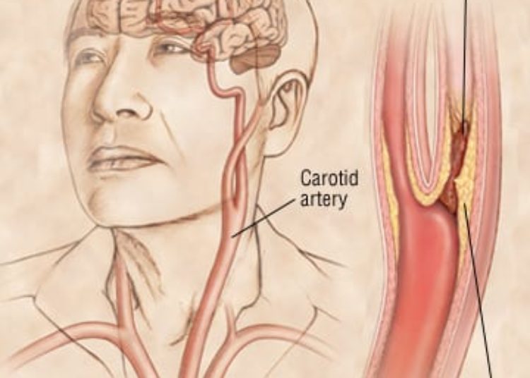 Patient Basics: Thrombotic Stroke