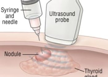 Patient Basics: Thyroid Cancer