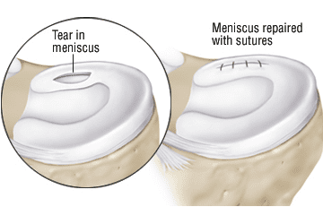 Torn Meniscus1