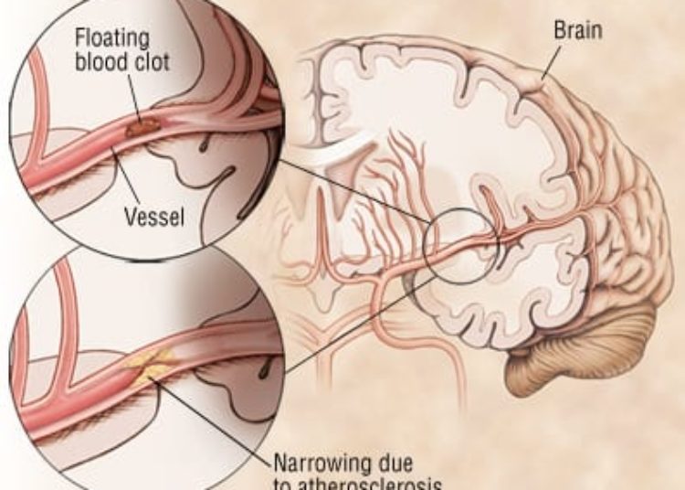 Patient Basics: Transient Ischemic Attack (TIA)