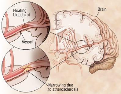 TIA (Transient Ischemic Attack): Symptoms & Treatment