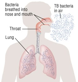 Tuberculosis in the UK Incidence and Prevalence