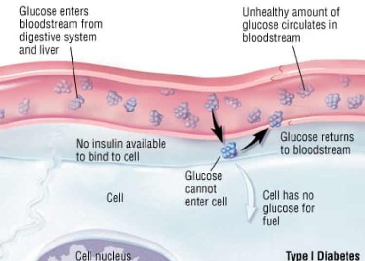 Patient Basics: Type 1 Diabetes Mellitus