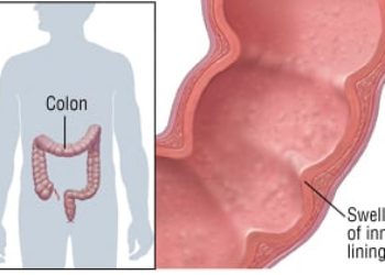 Patient Basics: Ulcerative Colitis