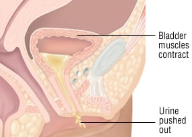 Patient Basics: Urinary Incontinence