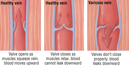 Patient Basics: Varicose Veins