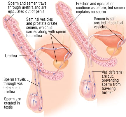 Patient Basics: Vasectomy