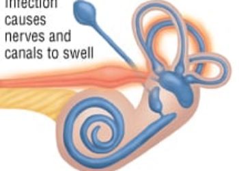 Patient Basics: Vertigo