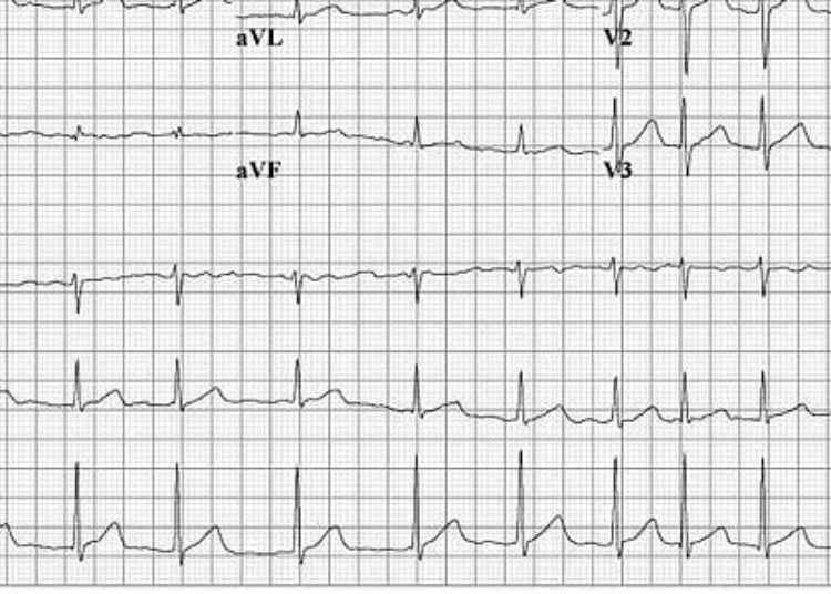 NSAIDs linked with serious bleeding in afib patients