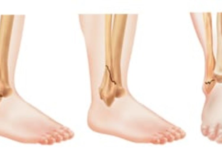 Patient Basics: Ankle Fracture