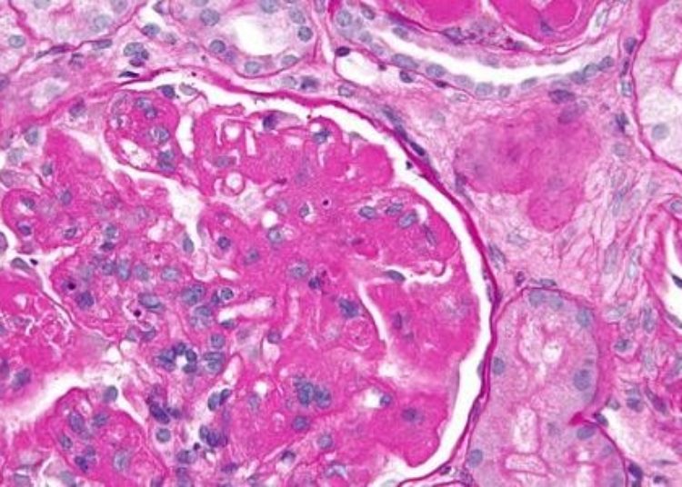 Multidrug induction therapy increases remission from lupus nephritis