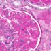Multidrug induction therapy increases remission from lupus nephritis