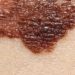Adding sargramostim to ipilimumab may improve survival in advanced melanoma