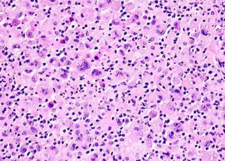 Dacomitinib may be effective in EGFR-associated lung cancer