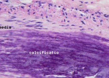 Imaging of atherosclerotic inflammation possible with fluorine MRI