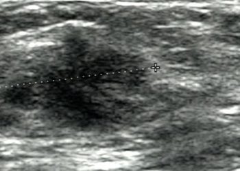 Breast ultrasound screening model reveals increased costs for small benefits