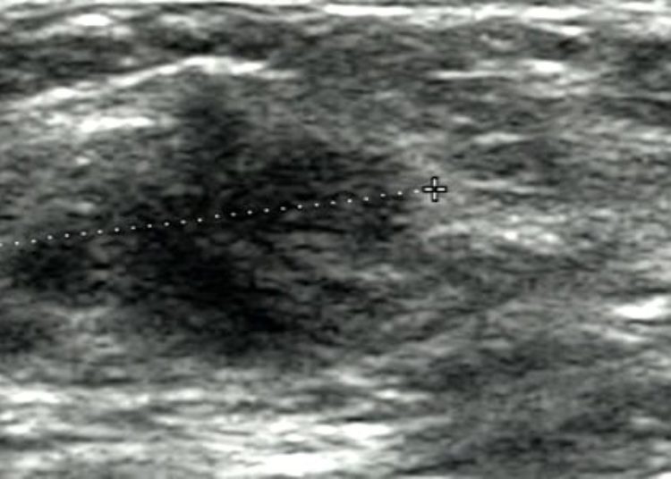Breast ultrasound screening model reveals increased costs for small benefits