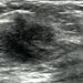 Breast ultrasound screening model reveals increased costs for small benefits
