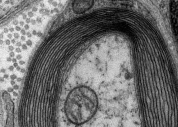 Targeted MRI may improve sensitivity for multiple sclerosis diagnosis