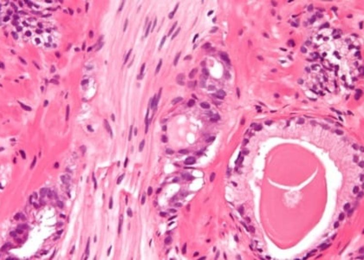 Long-term active surveillance may be safe in low-risk prostate cancer