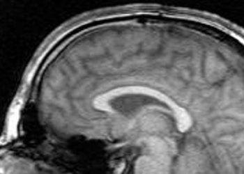 “No Evidence of Disease Activity” may be useful goal in multiple sclerosis