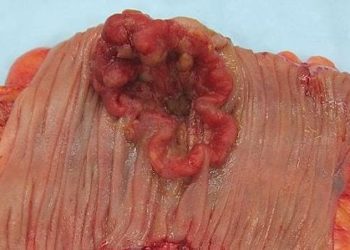 Racial differences in colorectal cancer survival linked to health at initial diagnosis