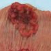 Racial differences in colorectal cancer survival linked to health at initial diagnosis