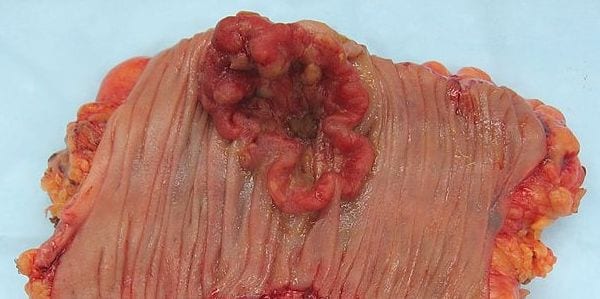 coloncancer
