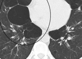 Emphysema-like lung on CT associated with increased mortality